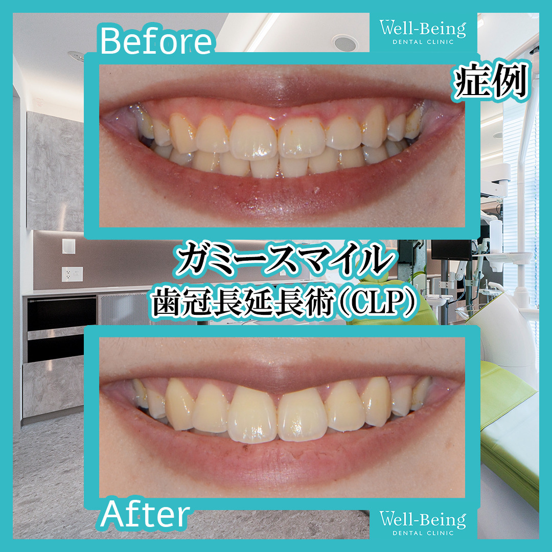 ガミースマイル（歯冠長延長術）の治療前後の一例（Before/After）※効果には個人差があります