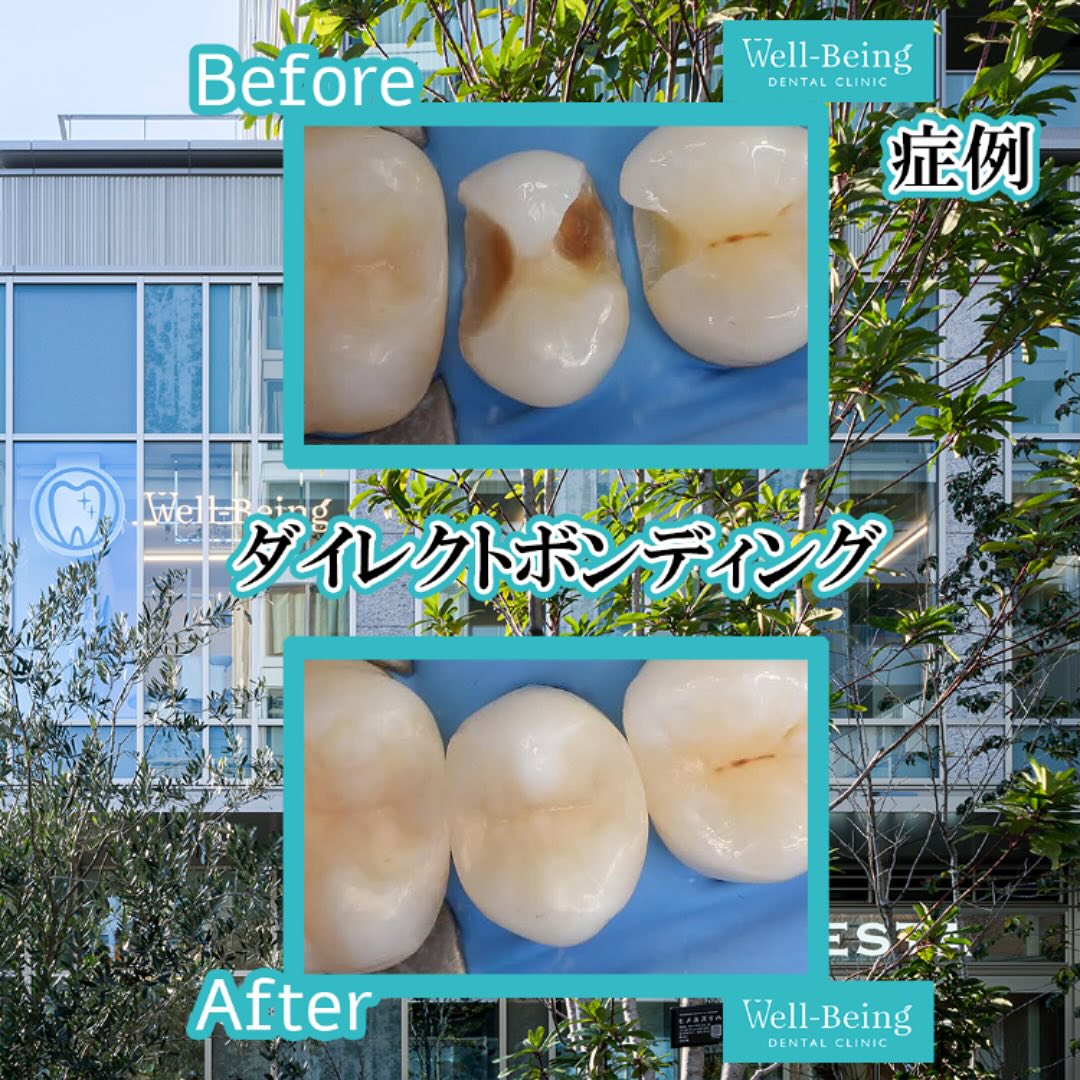 ダイレクトボンディングの治療前後の一例（Before/After）※効果には個人差があります