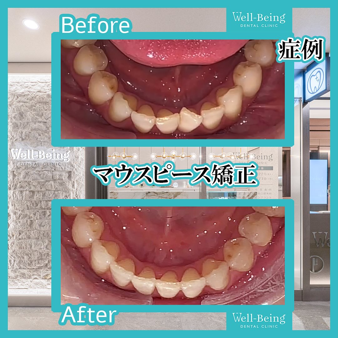 マウスピース矯正（インビザライン）の治療前後の一例（Before/After）※効果には個人差があります