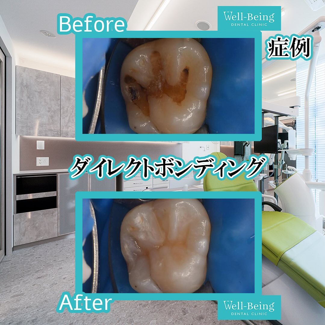 ダイレクトボンディングの治療前後の一例（Before/After）※効果には個人差があります