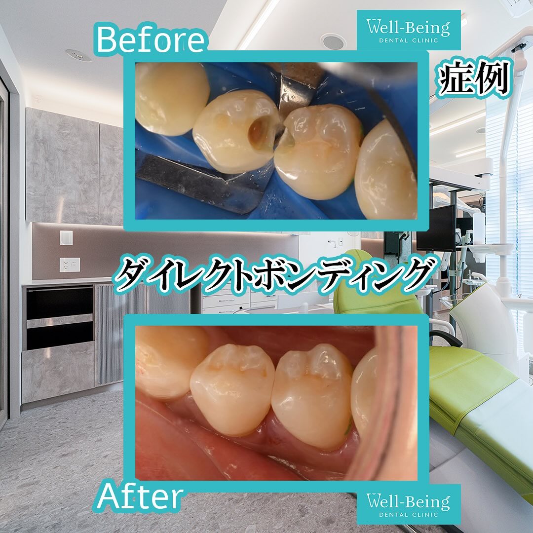 ダイレクトボンディングの治療前後の一例（Before/After）※効果には個人差があります