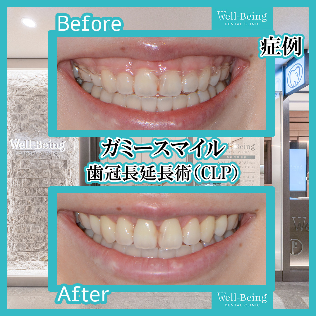 ガミースマイル（歯冠長延長術）の治療前後の一例（Before/After）※効果には個人差があります