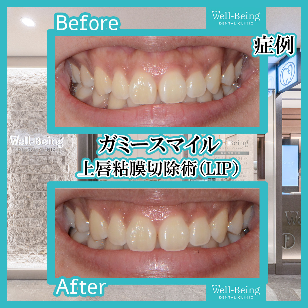 リップリポジショニング（上唇粘膜切除術）の治療前後の一例（Before/After）※効果には個人差があります
