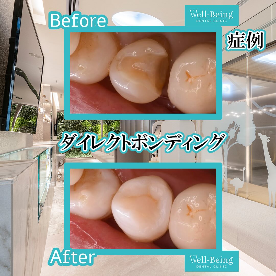 ダイレクトボンディングの治療前後の一例（Before/After）※効果には個人差があります