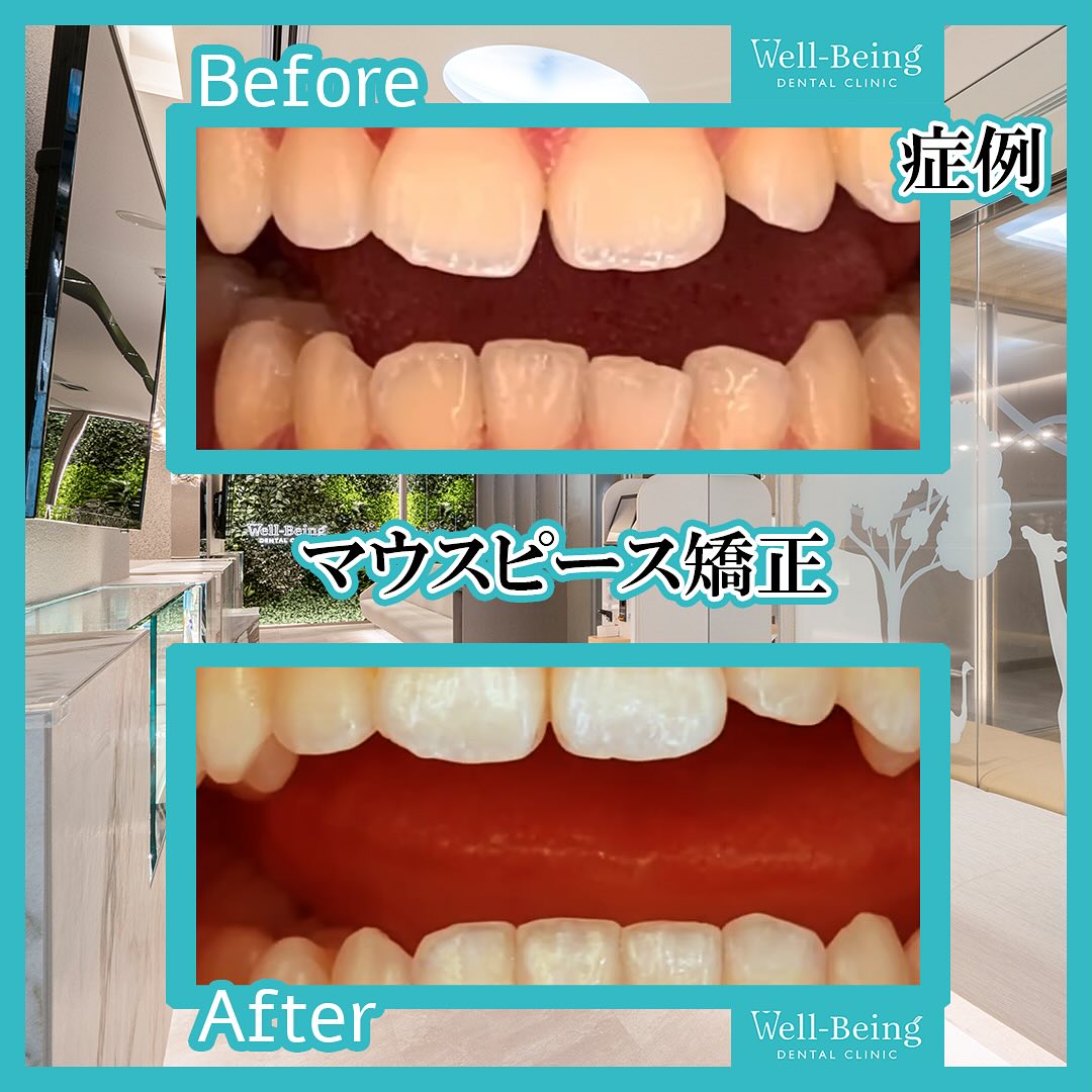 マウスピース矯正（インビザライン）の治療前後の一例（Before/After）※効果には個人差があります