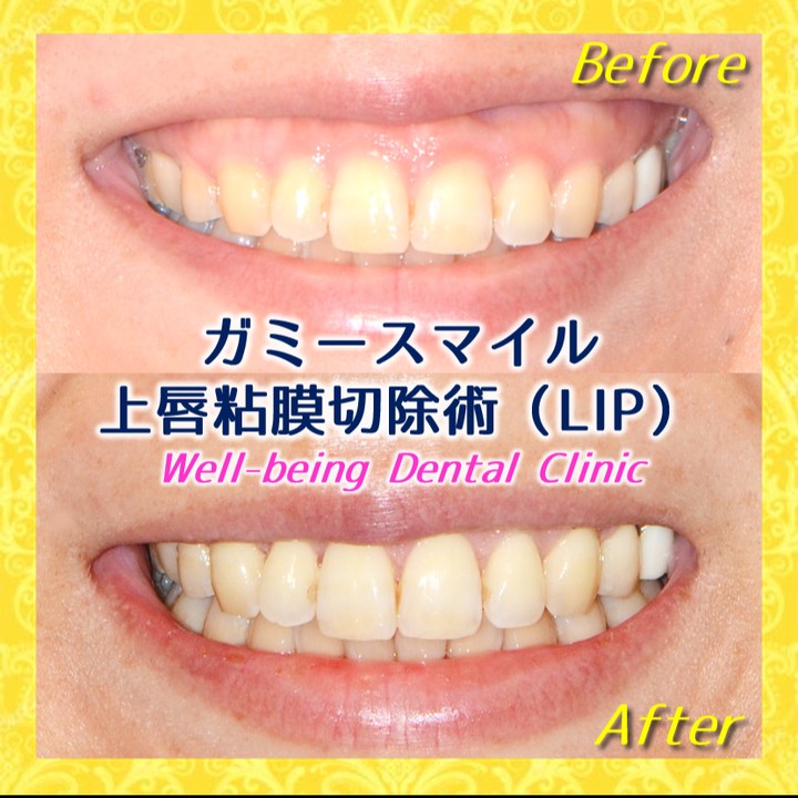 リップリポジショニング（上唇粘膜切除術）の治療前後の一例（Before/After）※効果には個人差があります