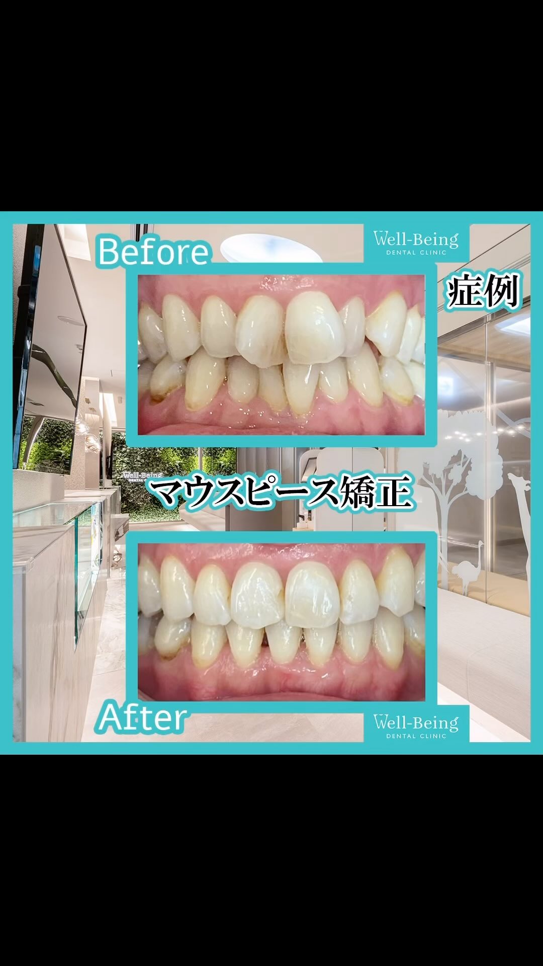 マウスピース矯正（インビザライン）の治療前後の一例（Before/After）※効果には個人差があります