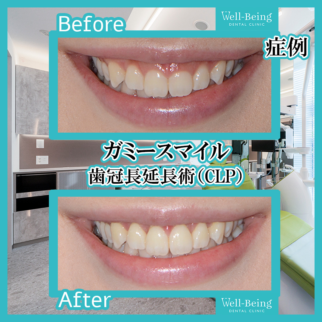 ガミースマイル（歯冠長延長術）の治療前後の一例（Before/After）※効果には個人差があります