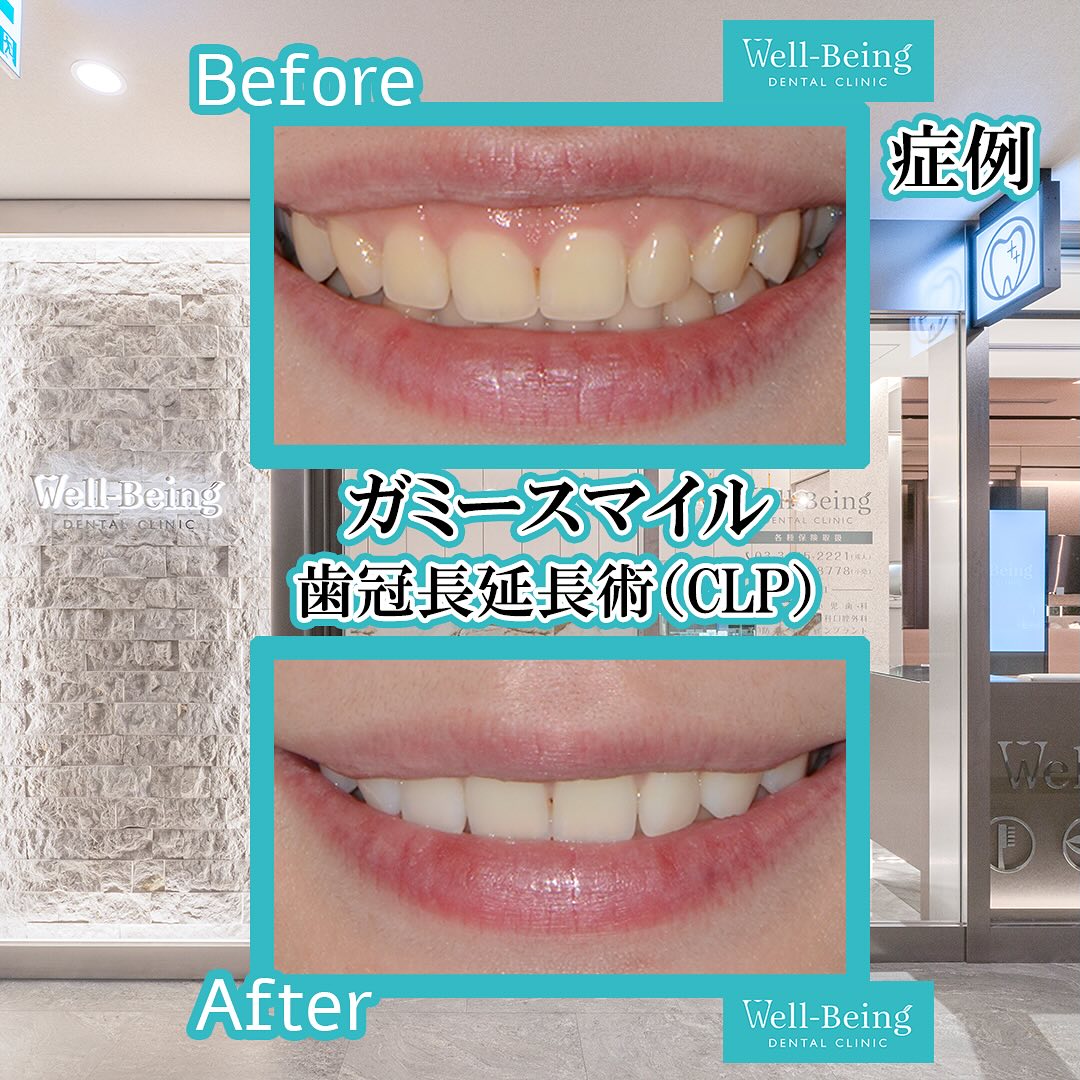 ガミースマイル（歯冠長延長術）の治療前後の一例（Before/After）※効果には個人差があります