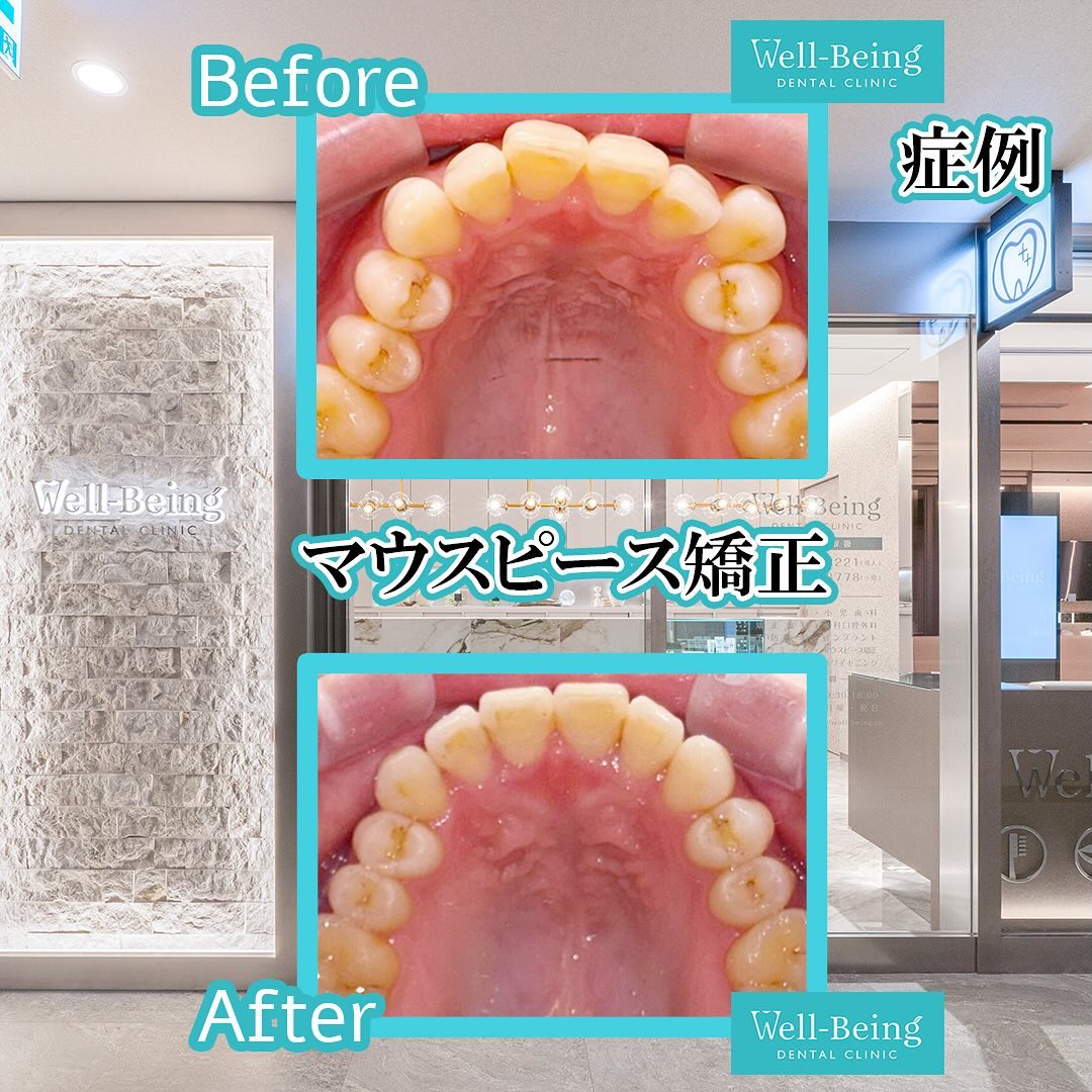 マウスピース矯正（インビザライン）の治療前後の一例（Before/After）※効果には個人差があります