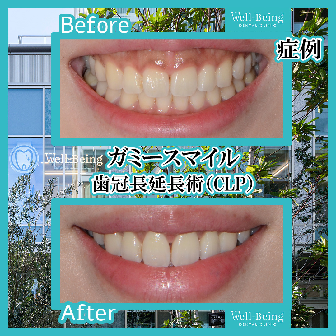 ガミースマイル（歯冠長延長術）の治療前後の一例（Before/After）※効果には個人差があります