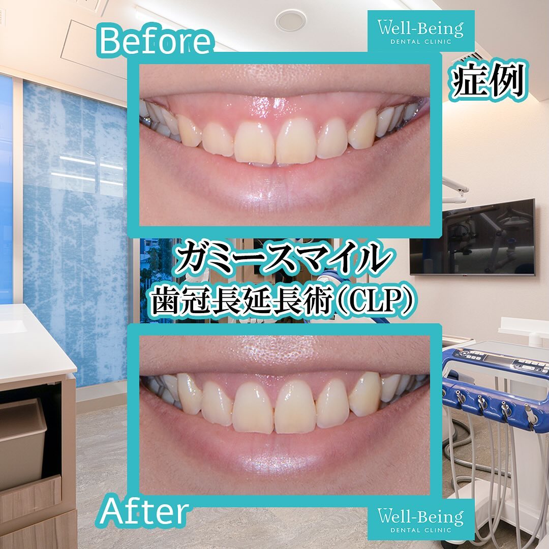 ガミースマイル（歯冠長延長術）の治療前後の一例（Before/After）※効果には個人差があります