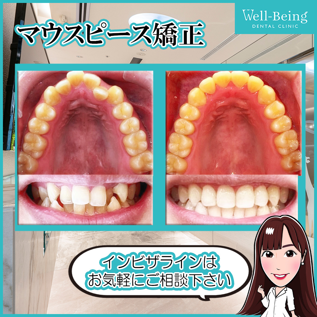 マウスピース矯正（インビザライン）の治療前後の一例（Before/After）※効果には個人差があります