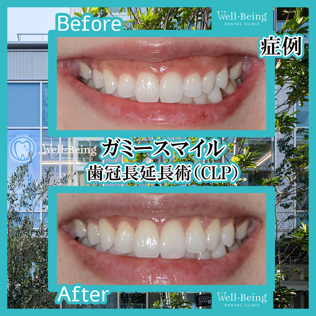 ガミースマイル（歯冠長延長術）の治療前後の一例（Before/After）※効果には個人差があります