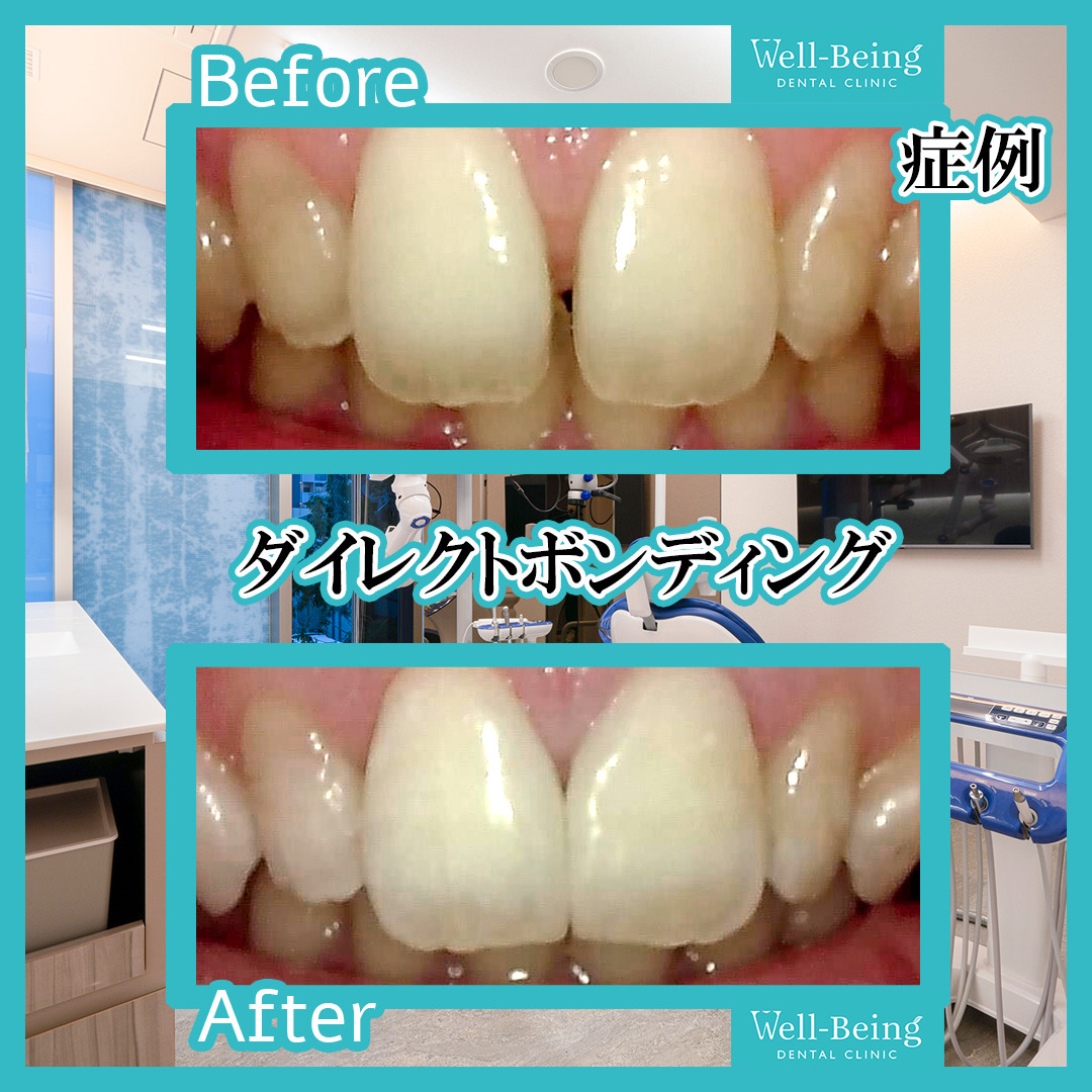 ダイレクトボンディング（すき間）の治療前後の一例（Before/After）※効果には個人差があります
