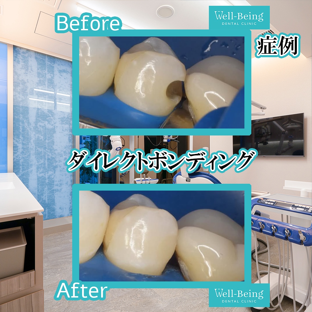 ダイレクトボンディングの治療前後の一例（Before/After）※効果には個人差があります