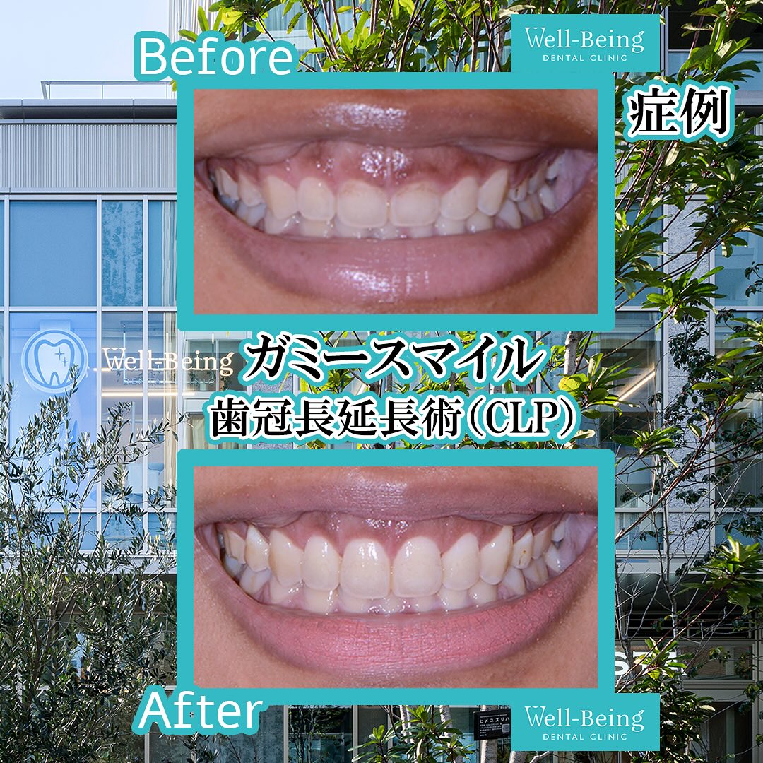 ガミースマイル（歯冠長延長術）の治療前後の一例（Before/After）※効果には個人差があります