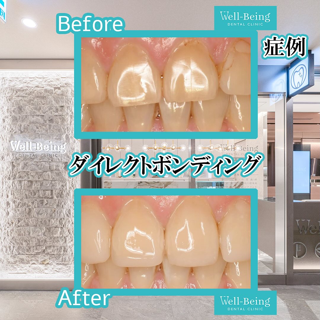 ダイレクトボンディング（すき間）の治療前後の一例（Before/After）※効果には個人差があります