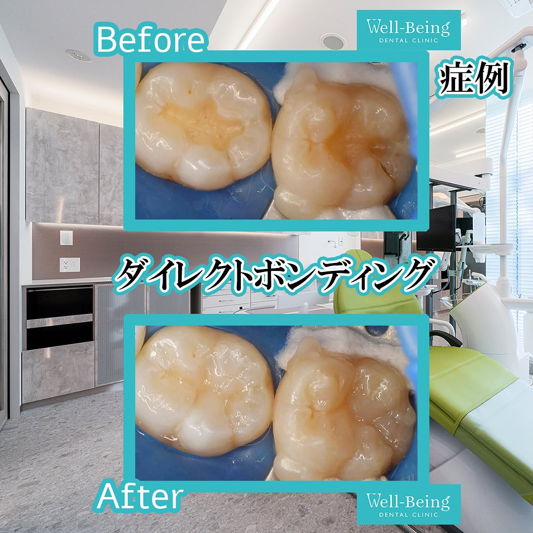 ダイレクトボンディングの治療前後の一例（Before/After）※効果には個人差があります