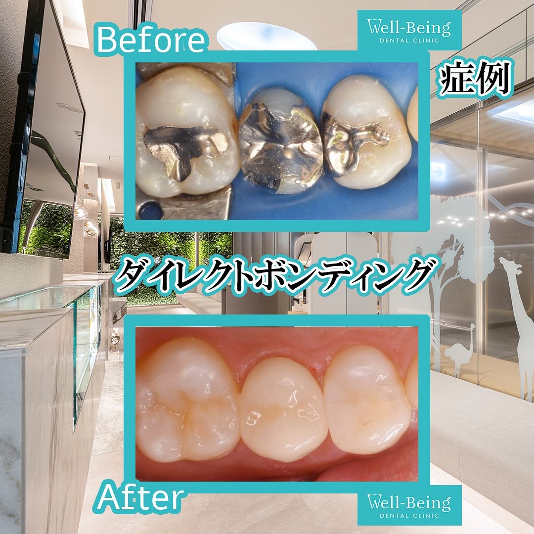 ダイレクトボンディングの治療前後の一例（Before/After）※効果には個人差があります